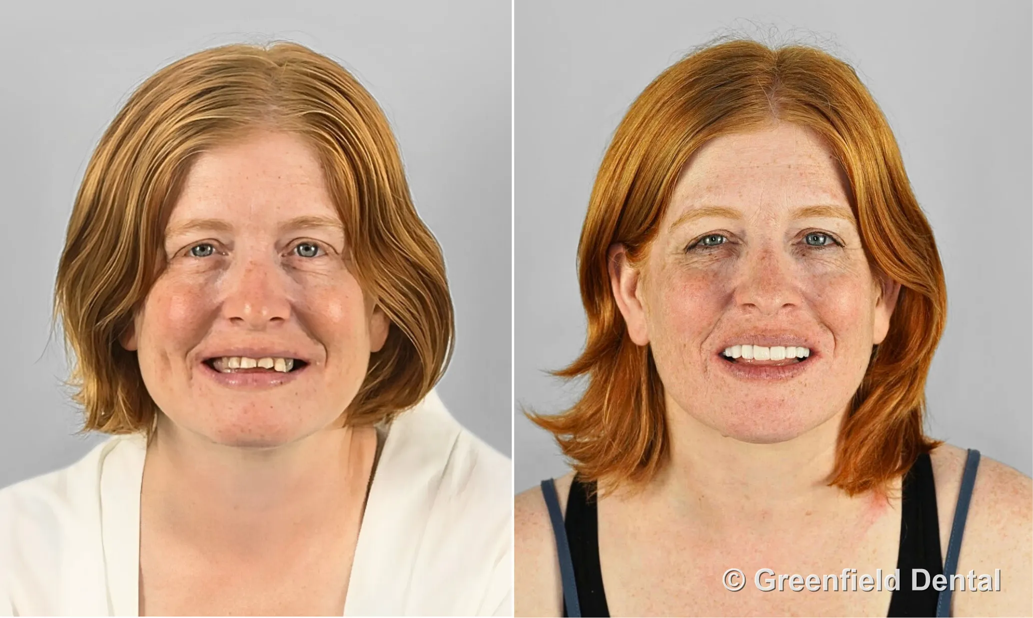 Full mouth reconstruction before and after — female patient, Greenfield Dental Hanoi