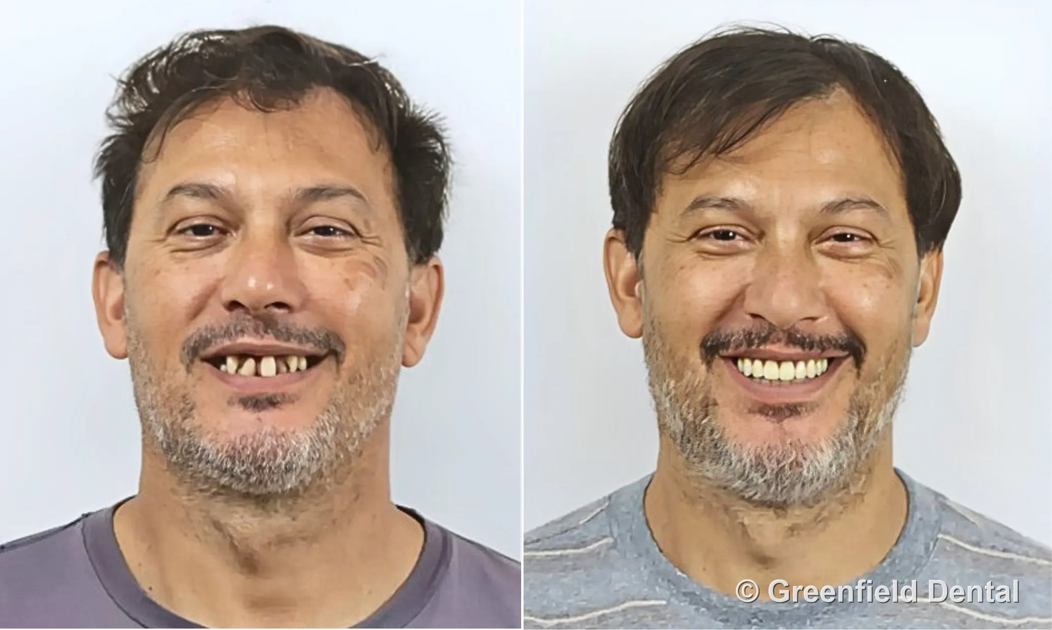 All-on-4 full arch before and after — Greenfield Dental Hanoi