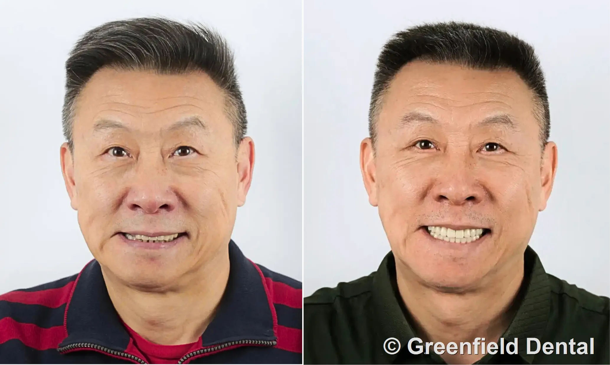Zirconia crowns before and after — Greenfield Dental Hanoi