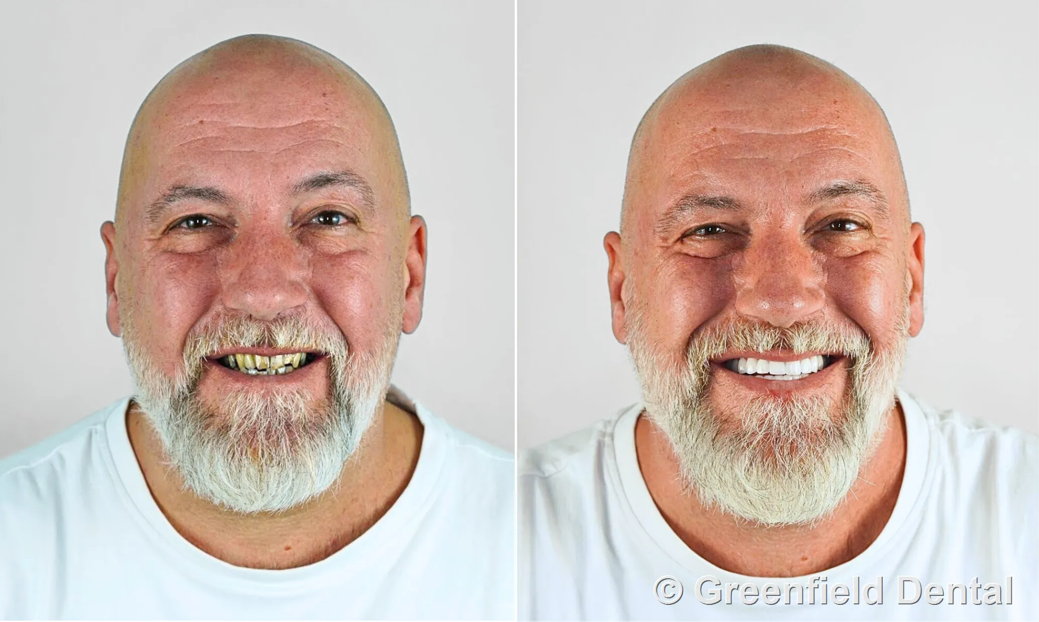 Zirconia crowns before and after — Greenfield Dental Hanoi