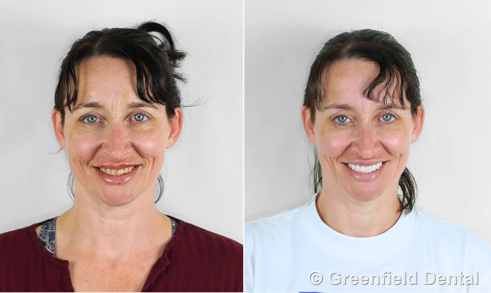Zirconia crowns before and after — female patient, Greenfield Dental Hanoi