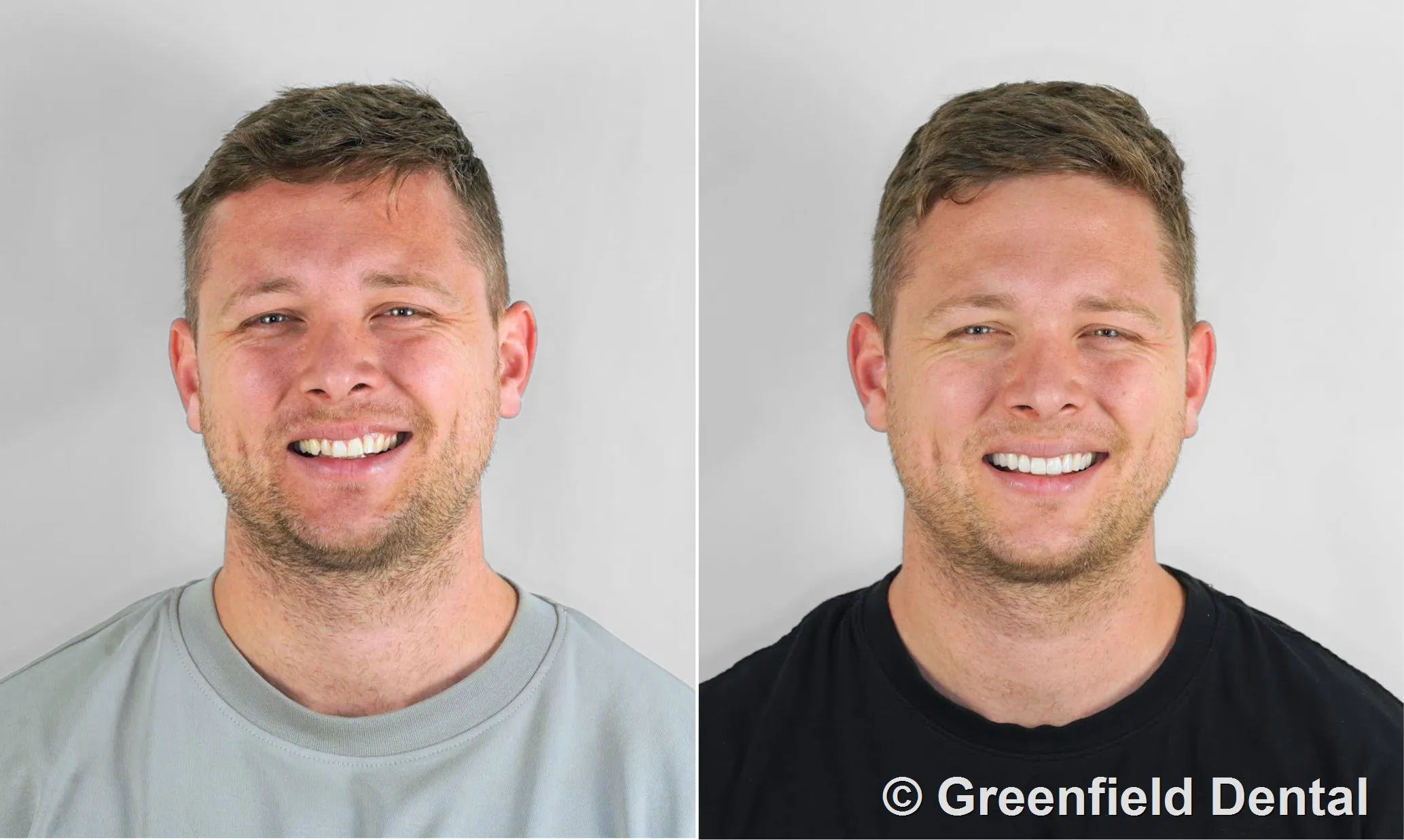 Veneers before and after — Greenfield Dental Hanoi