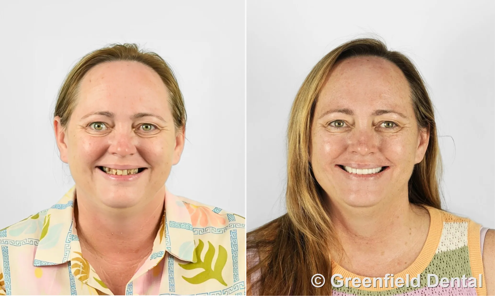 Zirconia crowns before and after — female patient, Greenfield Dental Hanoi