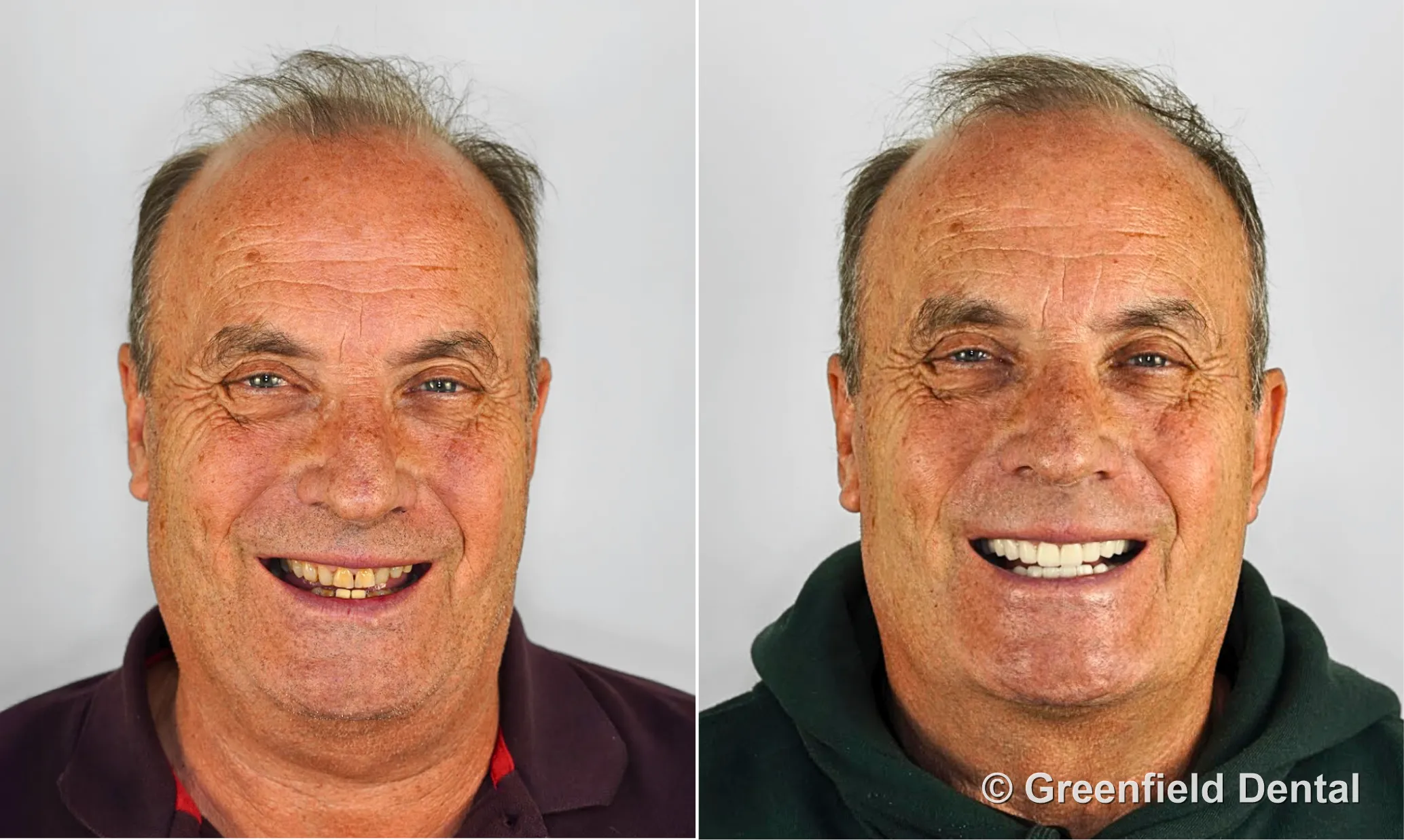 Full mouth reconstruction before and after — Greenfield Dental Hanoi