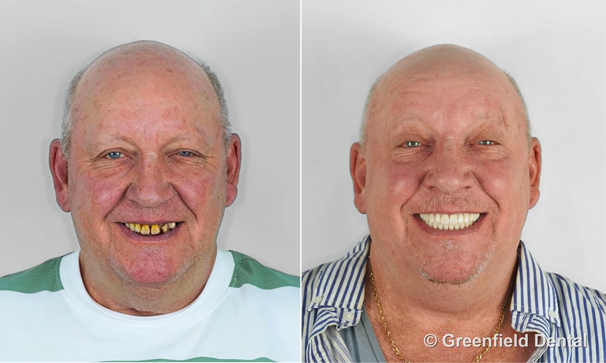 Full mouth reconstruction before and after — Greenfield Dental Hanoi