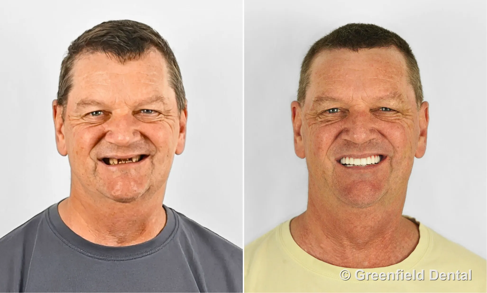All-on-4 full arch before and after — Greenfield Dental Hanoi