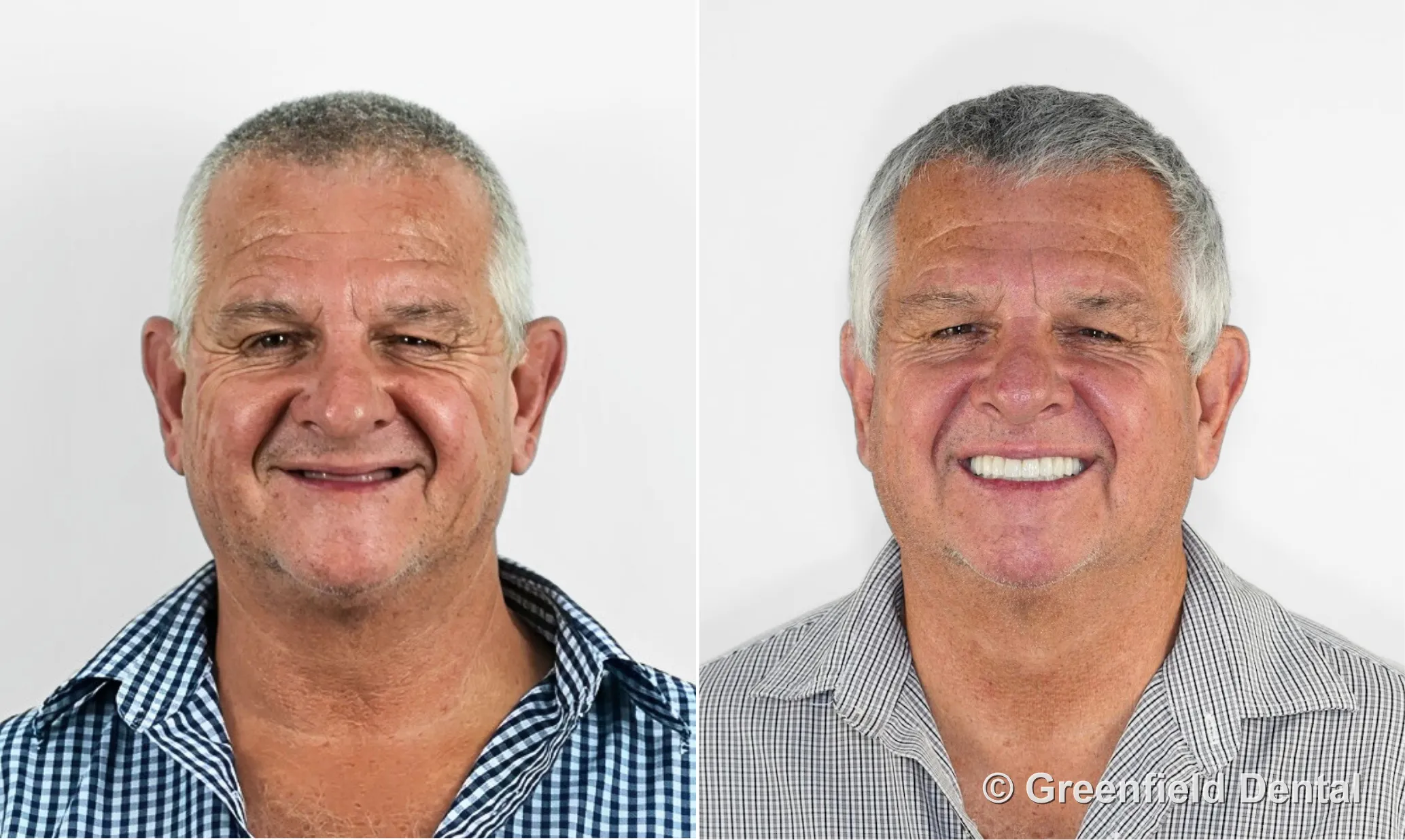Full mouth reconstruction before and after — Greenfield Dental Hanoi
