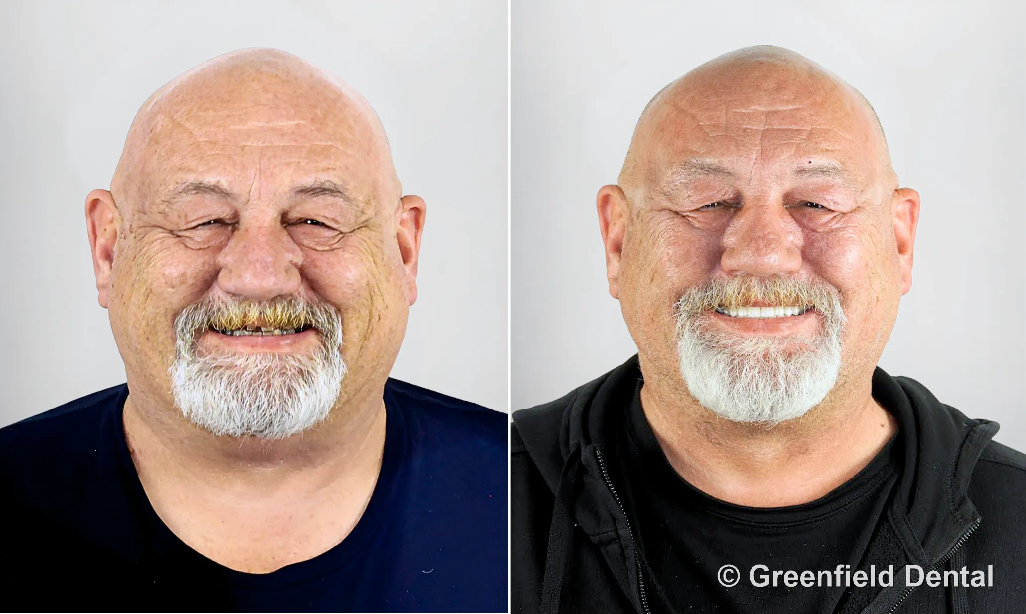 Full mouth reconstruction before and after — Greenfield Dental Hanoi