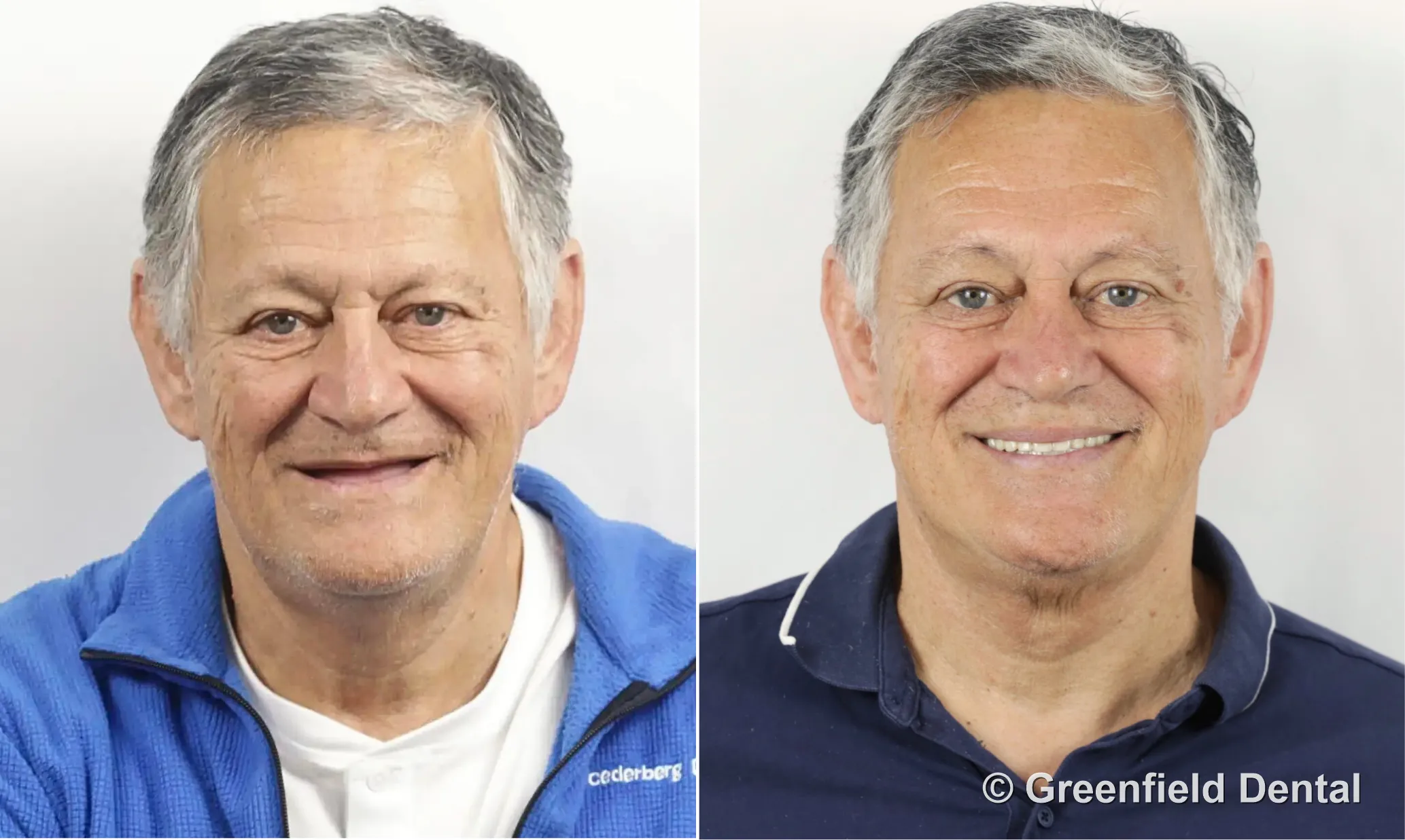 Full mouth reconstruction before and after — Greenfield Dental Hanoi