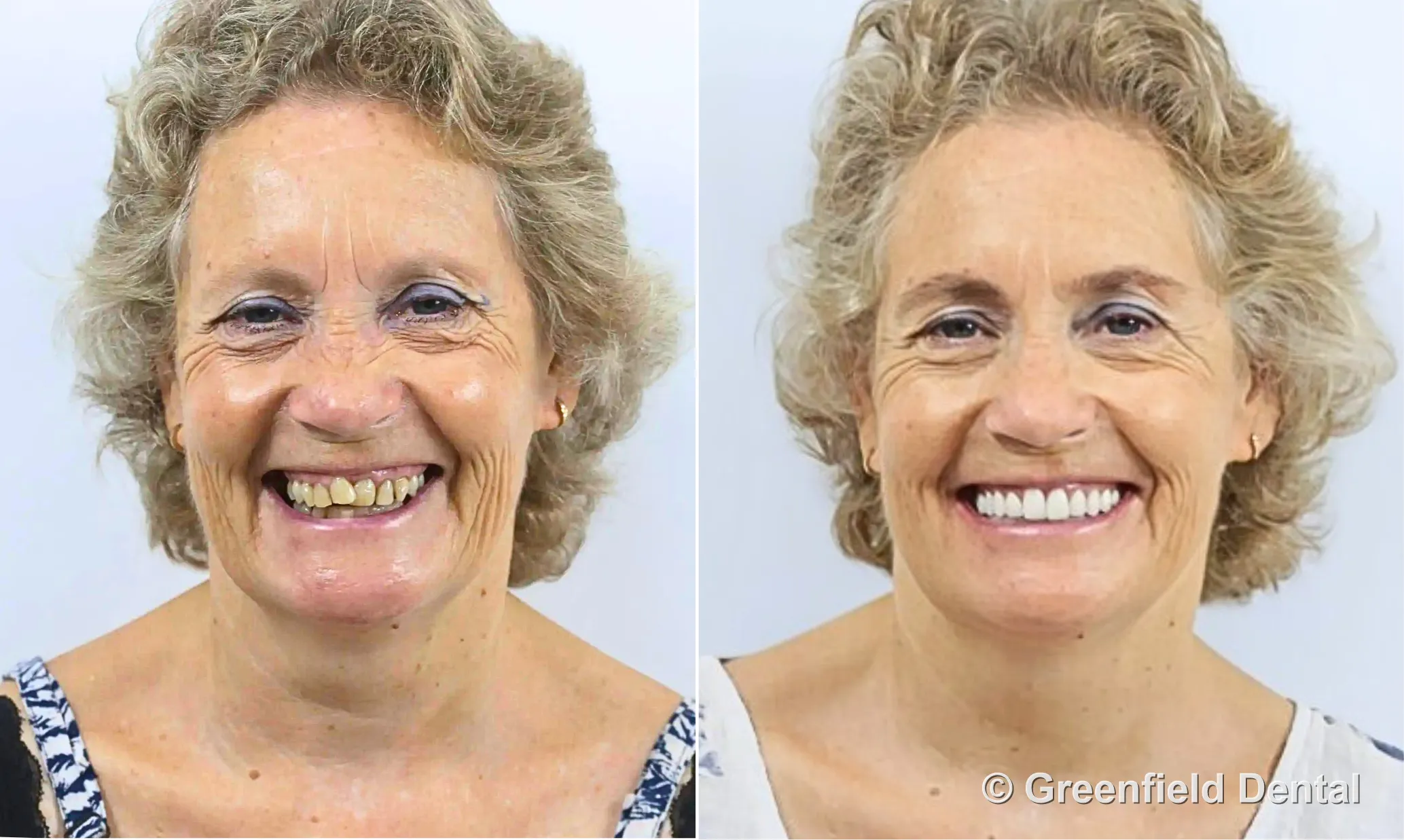 Full mouth reconstruction before and after — female patient, Greenfield Dental Hanoi