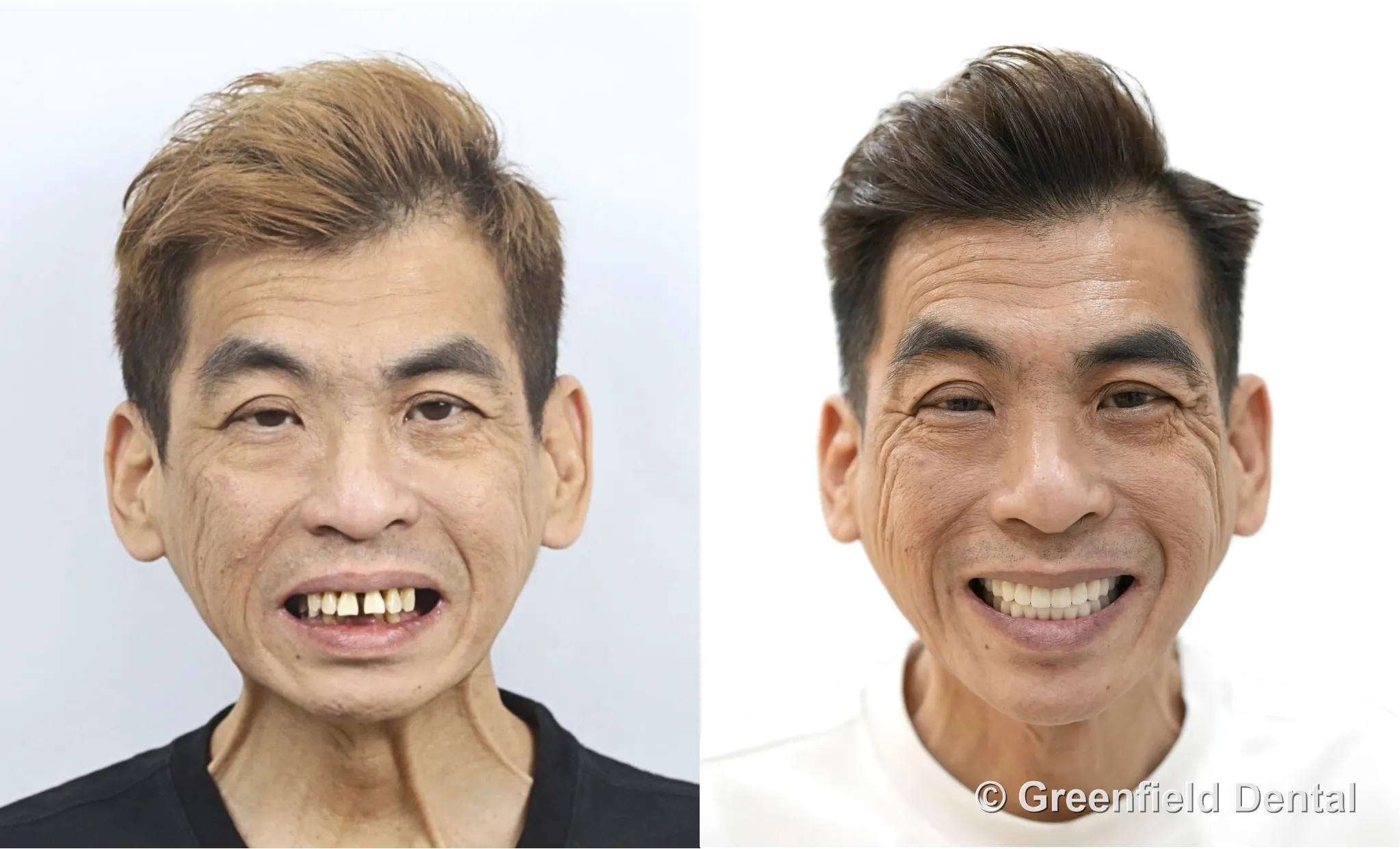 All-on-4 full arch before and after — Greenfield Dental patient Hanoi