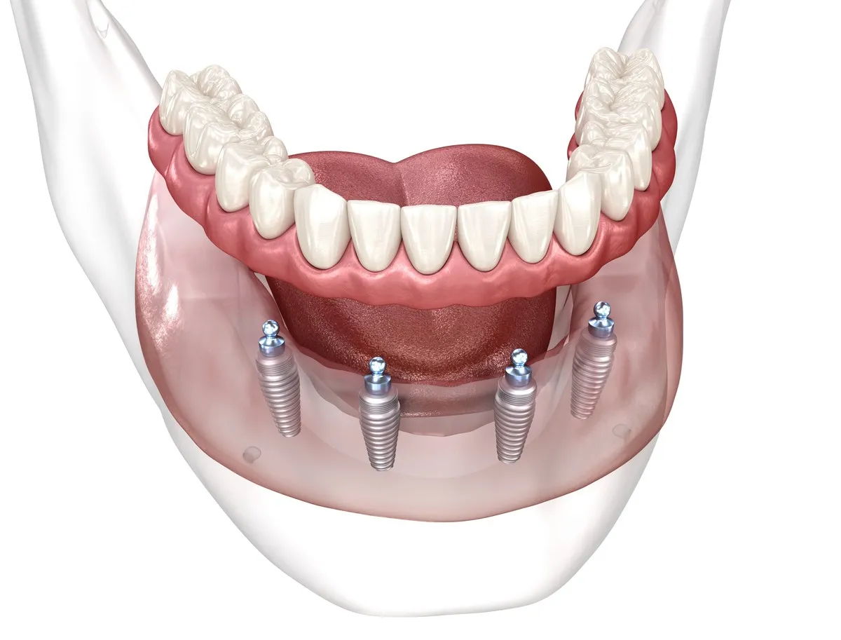 All-on-4 and All-on-6 Full Arch implants at Greenfield Dental Hanoi