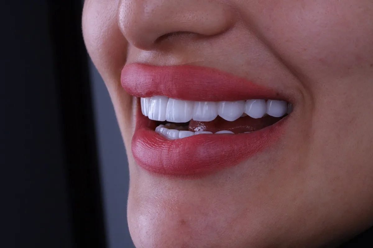 Smile Design at Greenfield Dental Hanoi