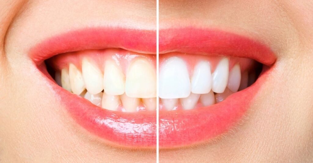 Những điều cần lưu ý trước khi tẩy trắng răng