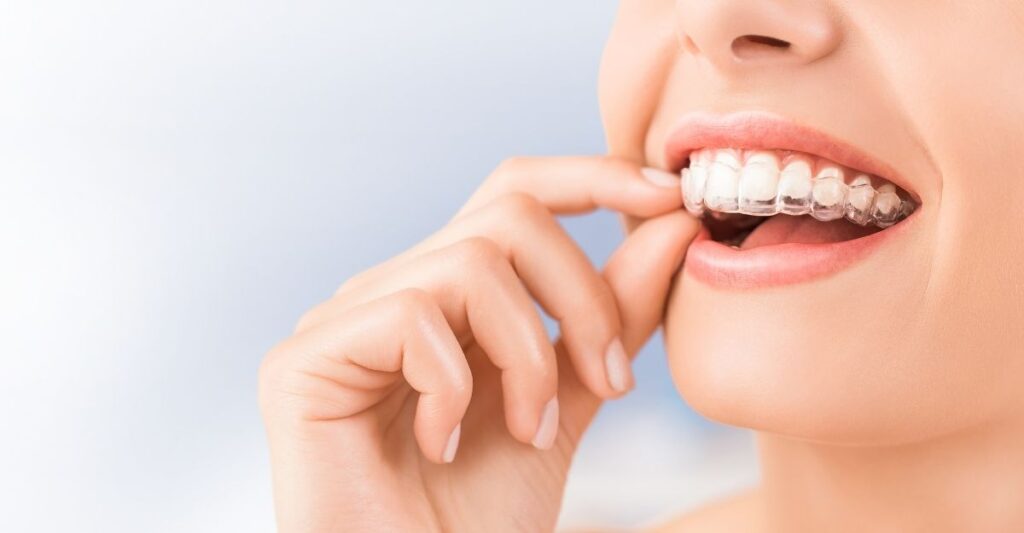 Vì sao mùa hè là thời điểm vàng để niềng răng?